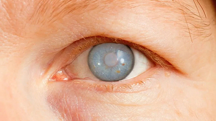 Cataract Eyes