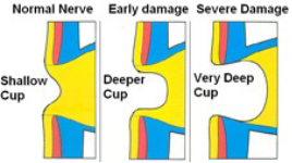 increased pressure affect the eye