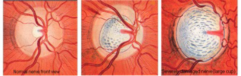 increased pressure affect the eye