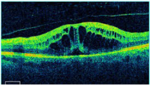 OCT scan
