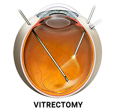 Vitrectomy